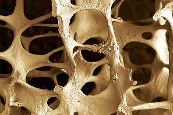 Immagine: Osteoporosi CC BY-SA 2.0 by German Tenorio  .jpg Creative Commons Attributon–ShareAlike 4.0 International (CC BY-SA 4.0)